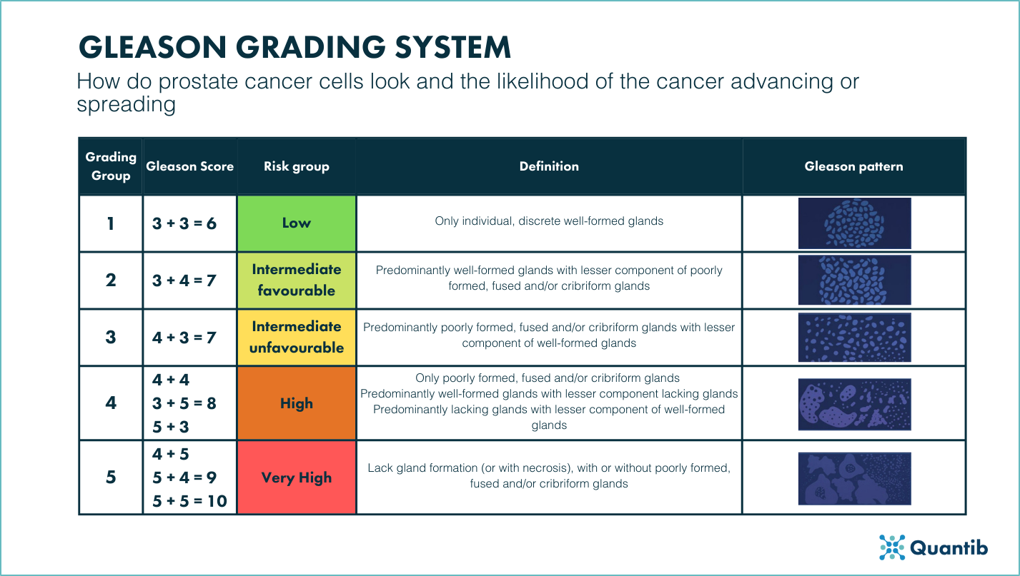 prostate-cancer-stages-gleason-score-d-mable-johnson